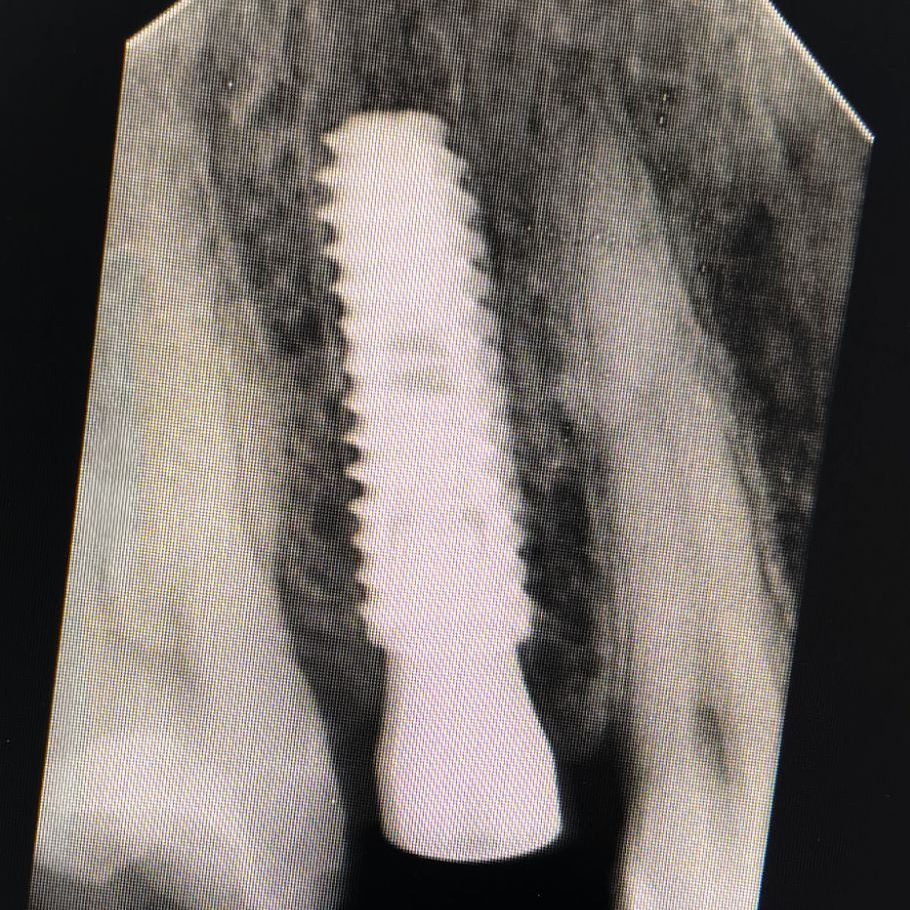 Immediate Dental Implant Surgery by Dr. Shahzad Hussain at SN Healthcare Multan